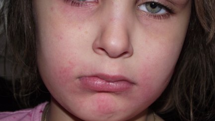 Anaphylaxis - the hidden impact