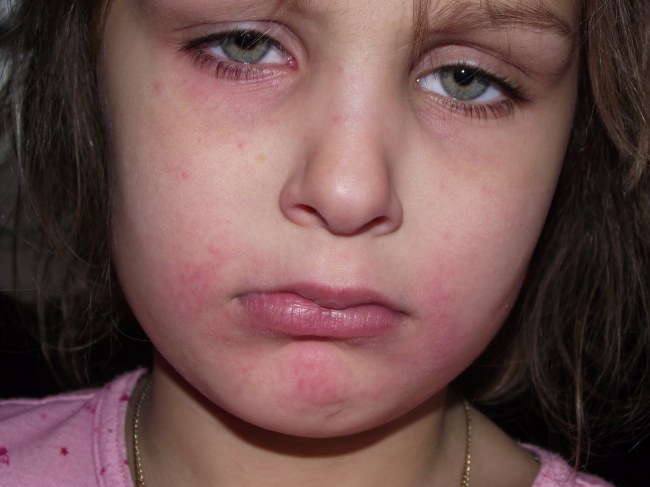 anaphylaxis | Safety First